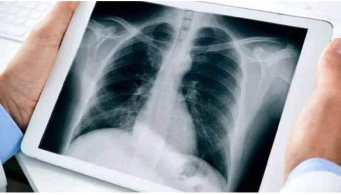 X ray